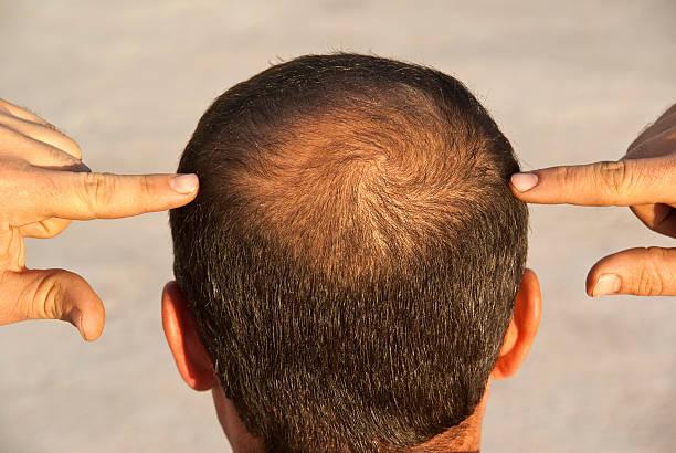 Norwood-Hamilton Scale: Tracking Male Pattern Baldness