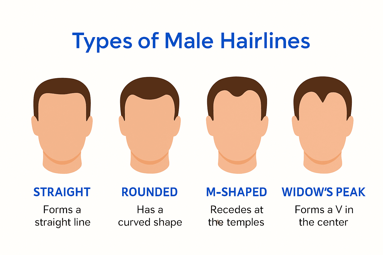 Comparison chart of male hairline types
