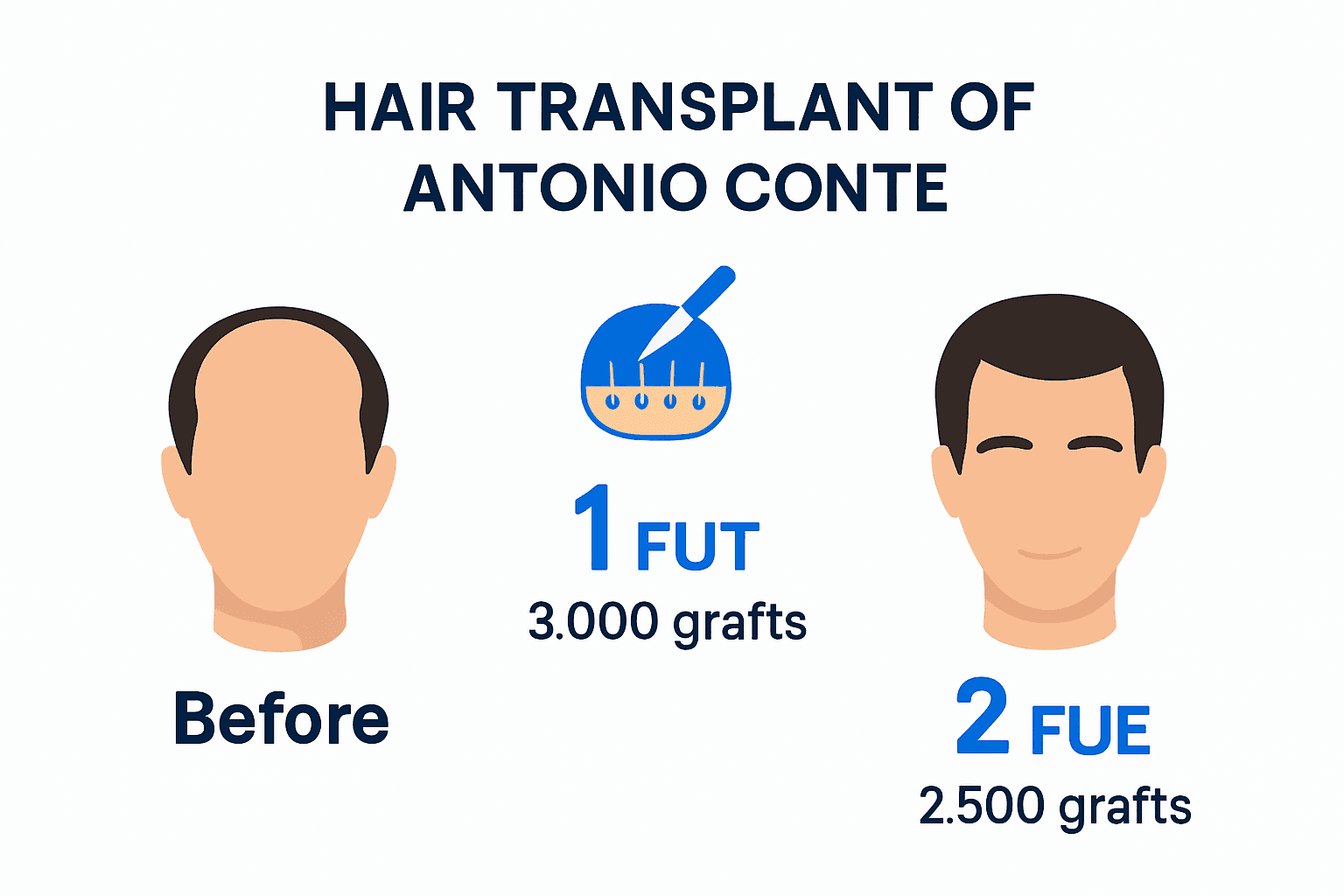 Infographie : étapes clés et chronologie d’une greffe de cheveux Conte