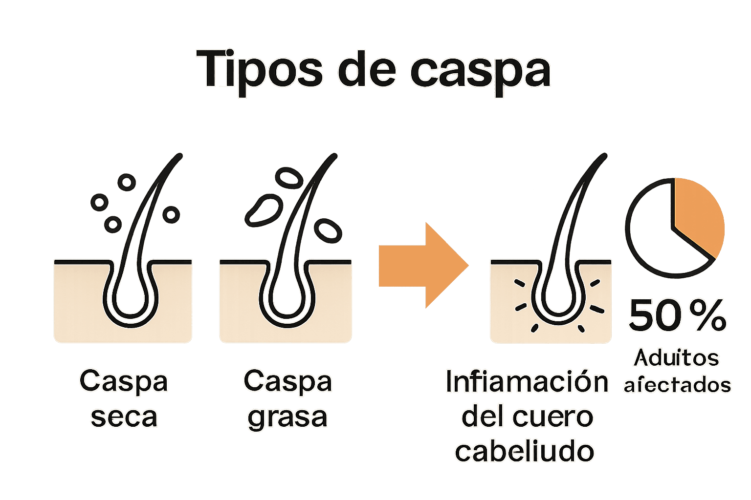 Infografía mostrando tipos de caspa e impacto folicular